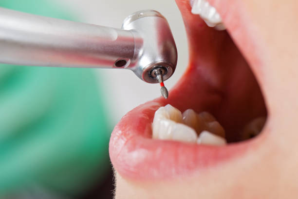 Best Emergency Root Canal Treatment in Cuthbert, GA